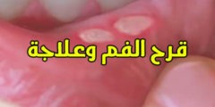 كيفية علاج تقرحات الفم نهائياً